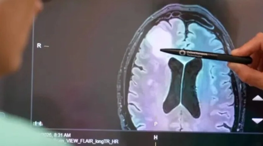 Nga javë në orë - teknologjia e re që përshpejton diagnostikimin e tumoreve të trurit