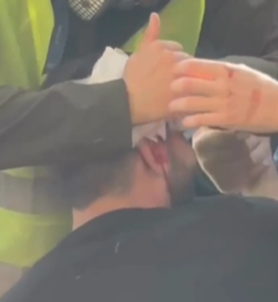 Policia shënjëstron në kokë të riun, e plagos me plumb gome, ‘vullnetarët’ ia fashojnë