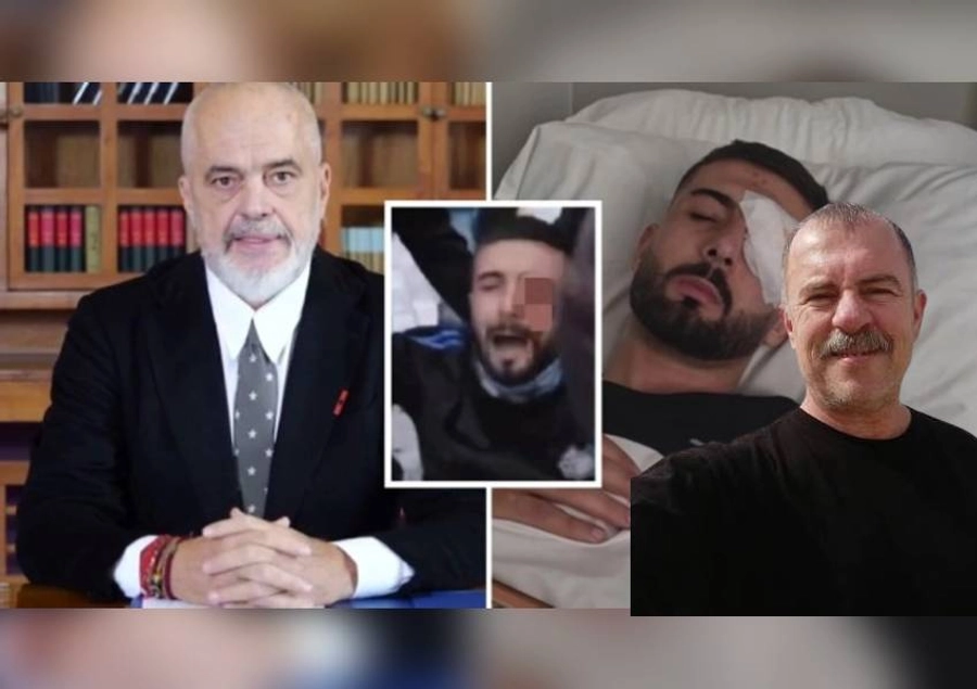 Rama tha se e nisi në avion të riun që humbi syrin nga salla VIP/ Eksperti: Pacienti nuk është oligark, ja procedurat